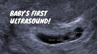 Babys First Ultrasound 6 Weeks Pregnant [upl. by Robet]