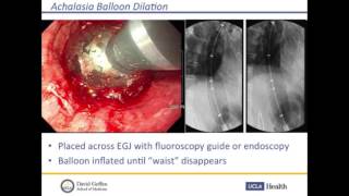 Pneumatic balloon dilation in achalasia [upl. by Peugia459]