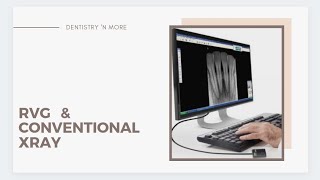 RVG DIGITAL vs CONVENTIONAL XRAY [upl. by Thomas]