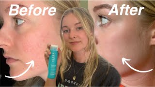 The BEST exfoliator you NEED to try for rosacea  sensitive skin  Rosacea Skin Care [upl. by Biernat]