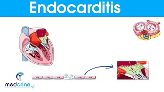 Endocarditis  causes symptoms pathophysiology diagnosis and treatment [upl. by Pavel]