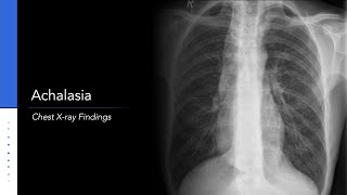 Achalasia Chest Xray Findings [upl. by Semele]