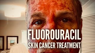 Fluorouracil Skin Treatment  Before During and After [upl. by Tavia]