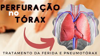 PNEUMOTÓRAX  O que fazer com ferimento no tórax Saiba o que é o Pneumotórax [upl. by Fital]