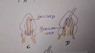 Hypospadias  TIP [upl. by Ardnuassac668]