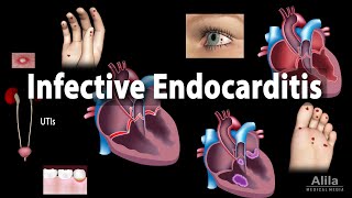 Infective Endocarditis Animation [upl. by Bak378]