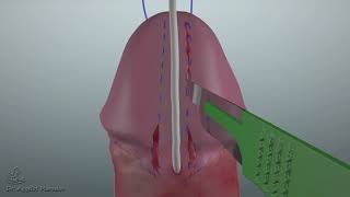 Distal Hypospadias Repair Animation [upl. by Rebmak690]