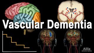 Vascular Dementia Pathology Animation [upl. by Lesnah]