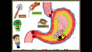 HELICOBACTER PYLORI GASTRITIS [upl. by Anitserp795]