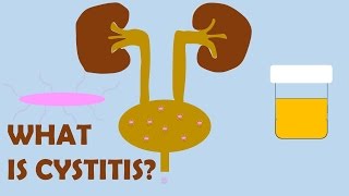 What is Cystitis [upl. by Nolitta]