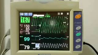 心電図モニター 実際の測定 VTACHY心室頻拍 NIHONKOHDEN LifeScope I [upl. by Akemrej]