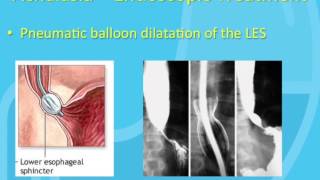 Treatment of Achalasia [upl. by Annamarie]