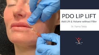 PDO Thread Lip Lift [upl. by Assena]