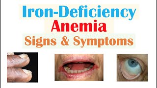 IronDeficiency Anemia Signs amp Symptoms ex Fatigue “Spoon Nails” Cracked Lips [upl. by Haleemaj]