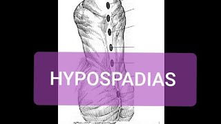 Hypospadias [upl. by Schou]