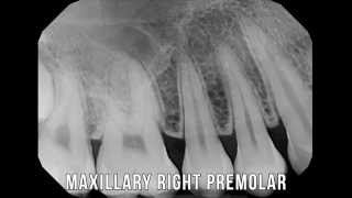 XRay lesson series 1  Full Mouth X rays [upl. by Abbye786]