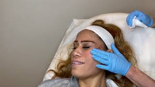 PDO Thread Lift treatment to lift the Mid and Lower Face after Dermal Filler and Botox [upl. by Yorztif]