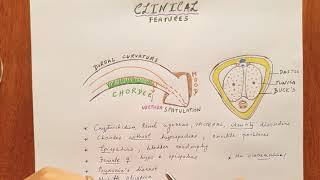 Hypospadias clinical features [upl. by Francklin]