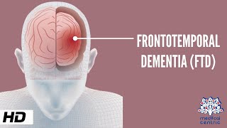 Frontotemporal Dementia Causes Signs and Symptoms Diagnosis and Treatment [upl. by Siravat]