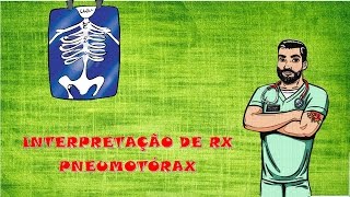 Interpretação de RX Pneumotórax e Hemotórax Maciço [upl. by Marcella]